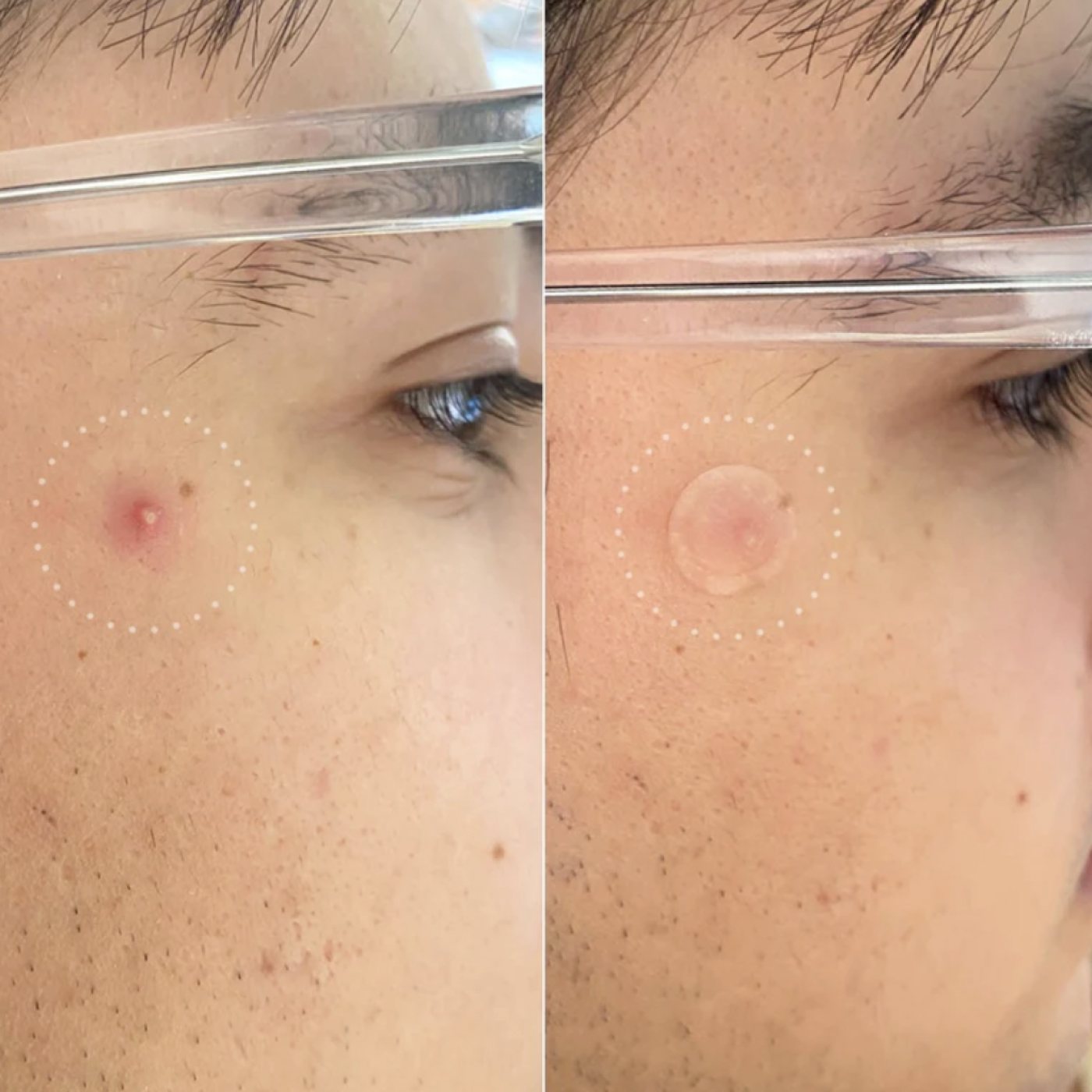 Mighty Patch Invisible+, The Ultra-Thin Acne Patch
